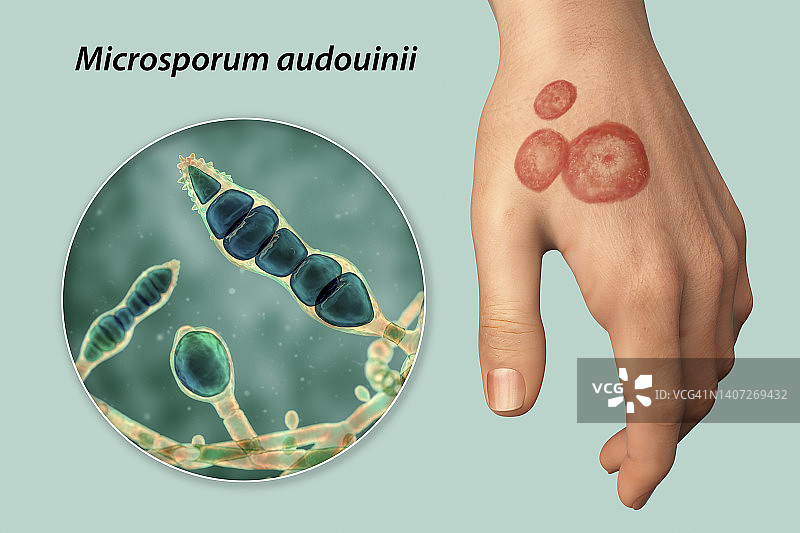 癣，图示图片素材