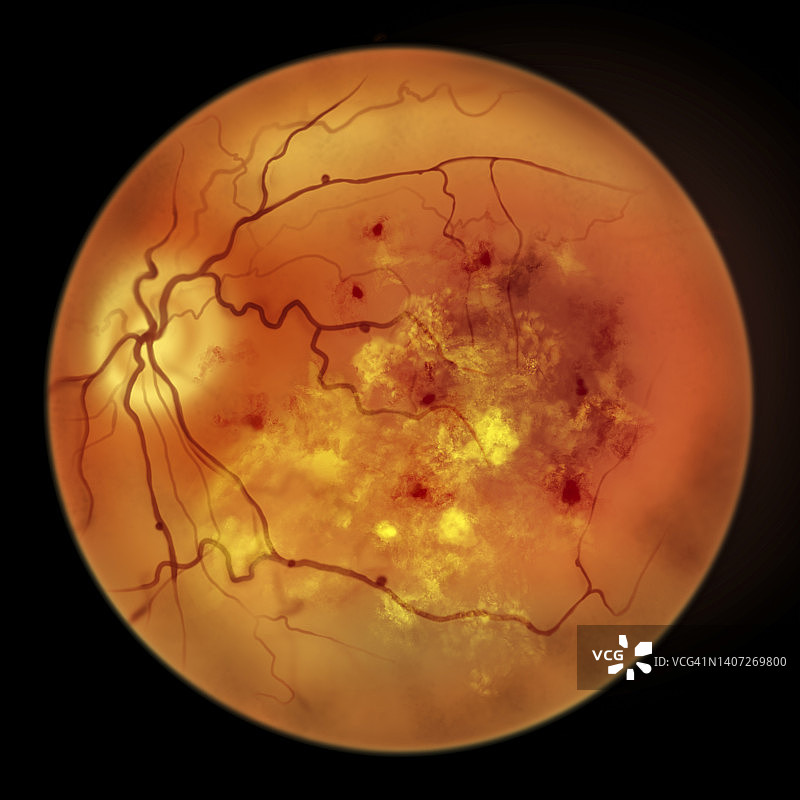 糖尿病导致视网膜损伤，插图图片素材