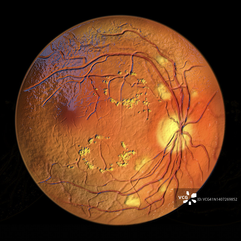 糖尿病导致视网膜损伤，插图图片素材