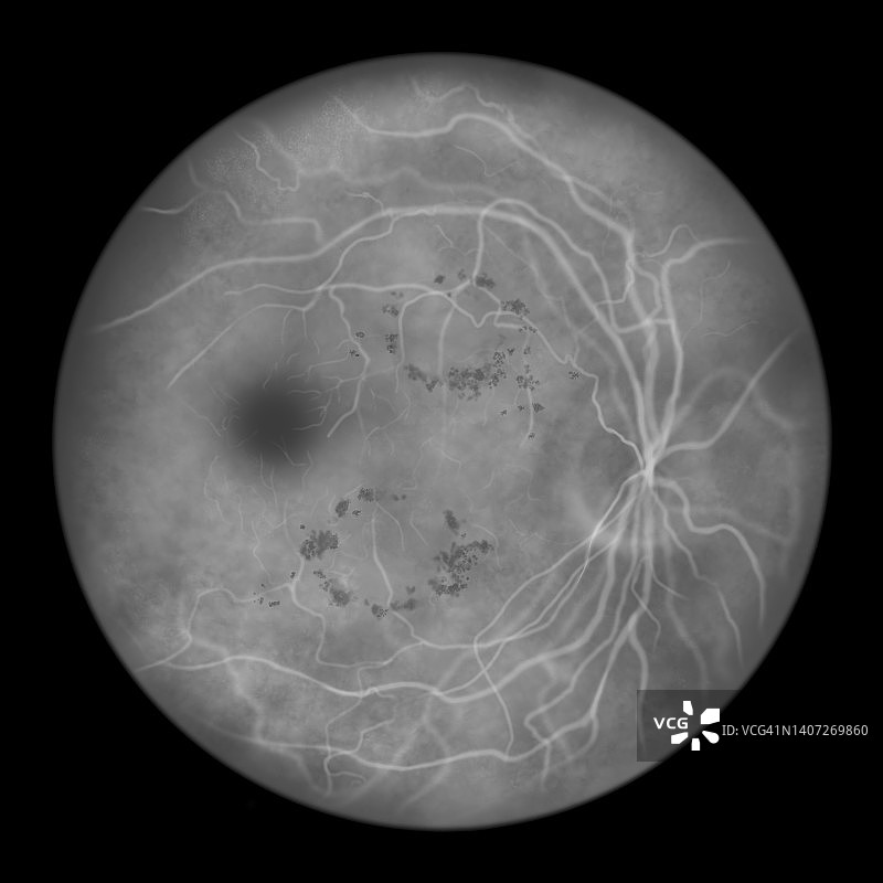 糖尿病导致视网膜损伤，插图图片素材
