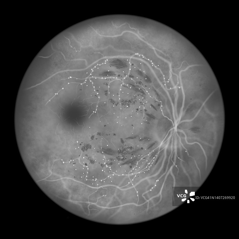 糖尿病导致视网膜损伤，插图图片素材