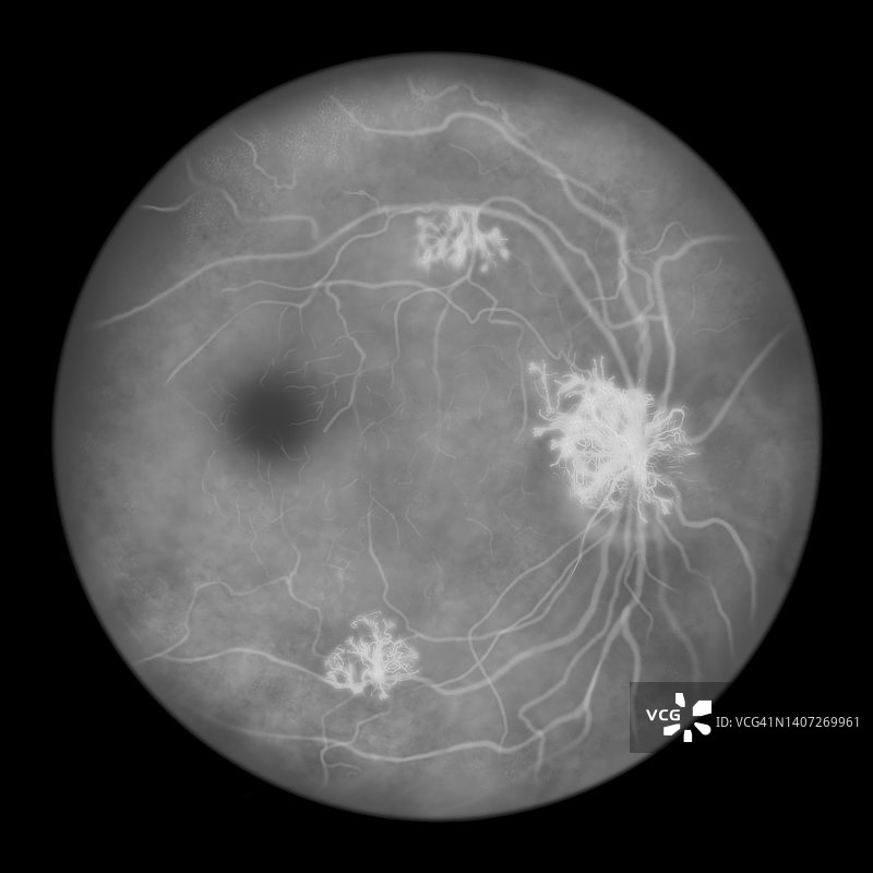 糖尿病导致视网膜损伤，插图图片素材