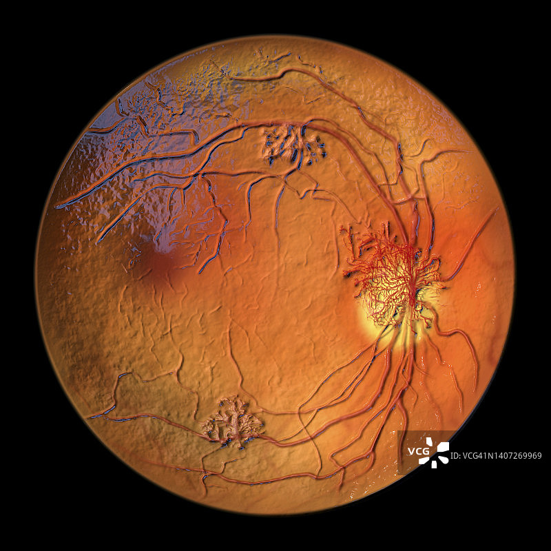糖尿病导致视网膜损伤，插图图片素材