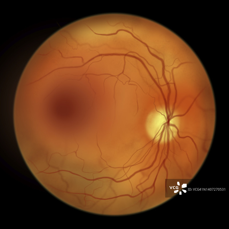 糖尿病导致视网膜损伤，插图图片素材