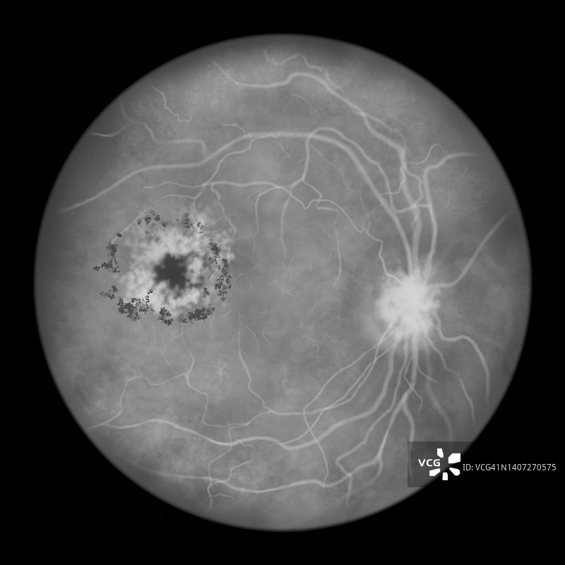 糖尿病导致视网膜损伤，插图图片素材