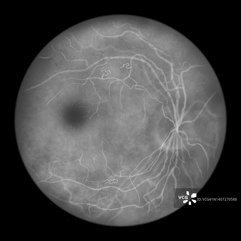 糖尿病导致视网膜损伤，插图图片素材