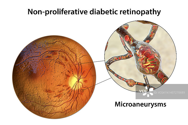 糖尿病导致视网膜损伤，插图图片素材