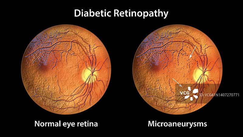 糖尿病导致视网膜损伤，插图图片素材