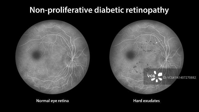 糖尿病导致视网膜损伤，插图图片素材