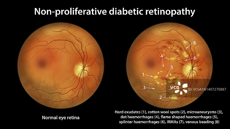 糖尿病导致视网膜损伤，插图图片素材