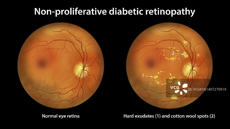 糖尿病导致视网膜损伤，插图图片素材