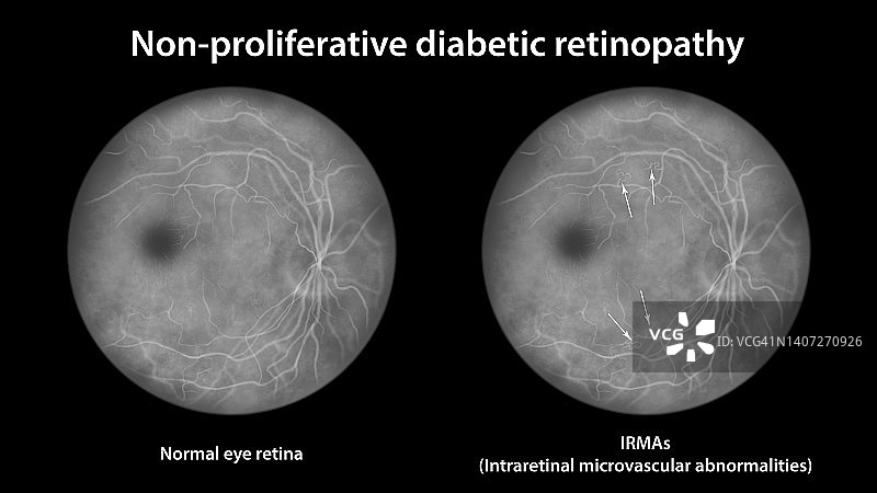糖尿病导致视网膜损伤，插图图片素材