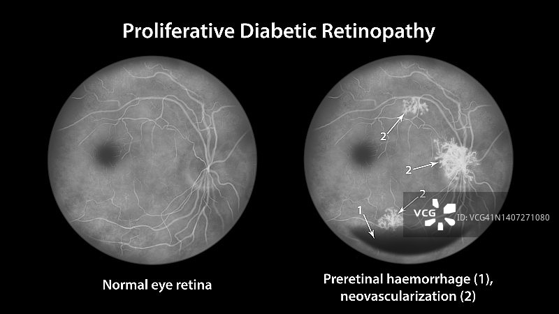 糖尿病导致视网膜损伤，插图图片素材