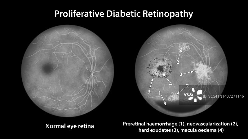 糖尿病导致视网膜损伤，插图图片素材