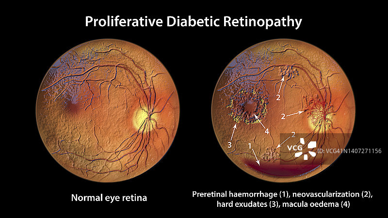 糖尿病导致视网膜损伤，插图图片素材