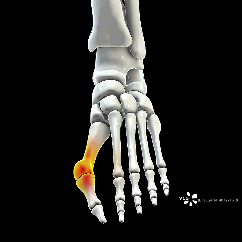 拇囊炎插图图片素材