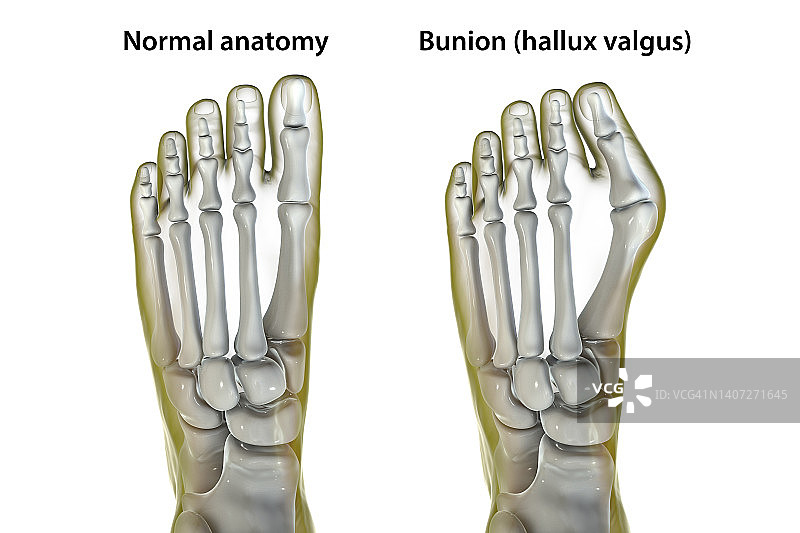 拇囊炎插图图片素材