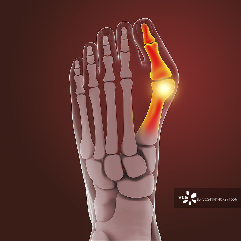 拇囊炎插图图片素材