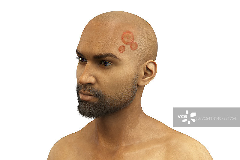 癣，图示图片素材