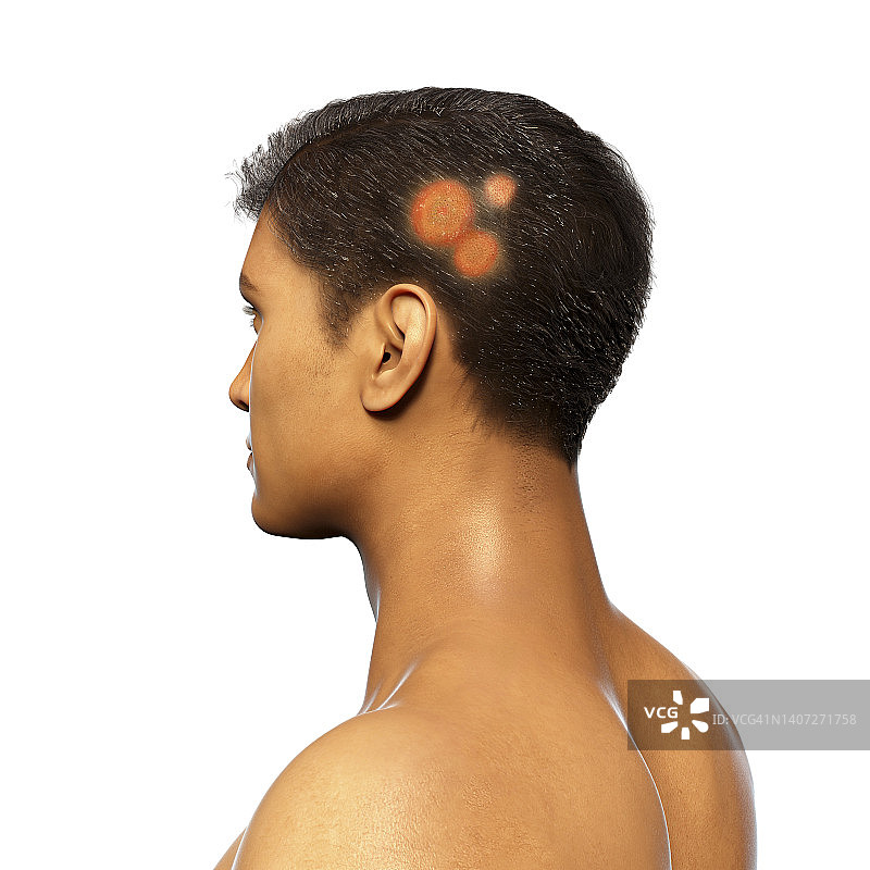 癣，图示图片素材