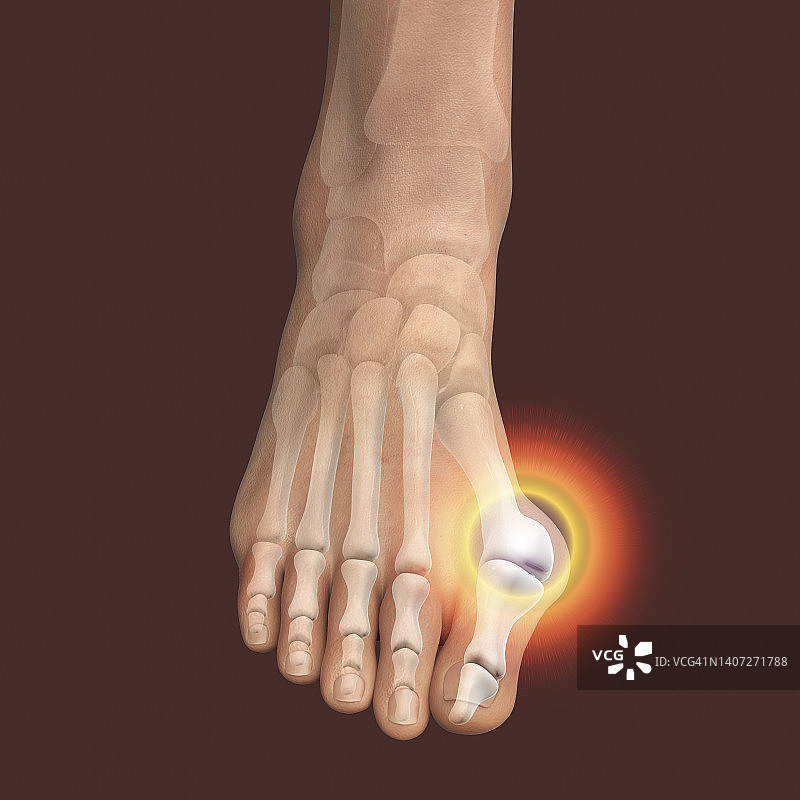 拇囊炎插图图片素材