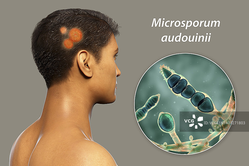 癣，图示图片素材