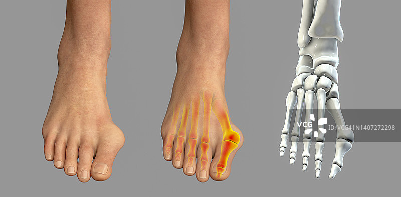拇囊炎插图图片素材