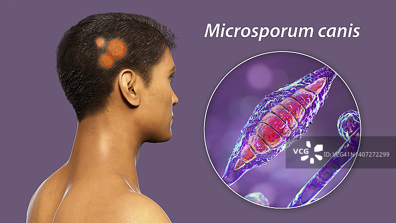 癣，图示图片素材