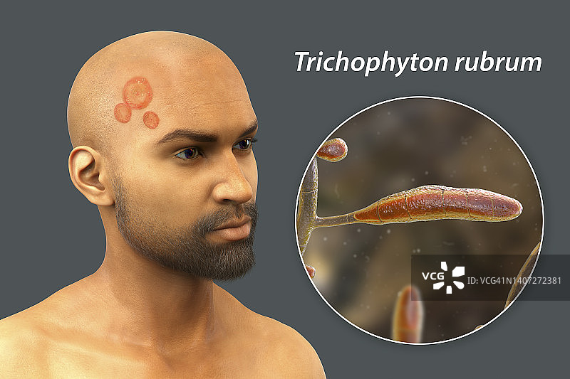 癣，图示图片素材