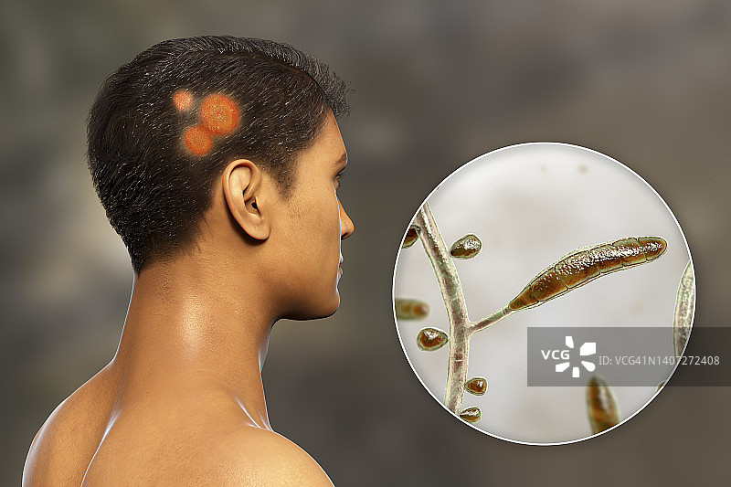 癣，图示图片素材