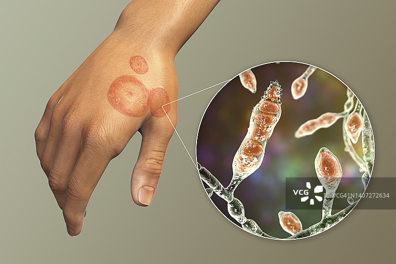 癣，图示图片素材