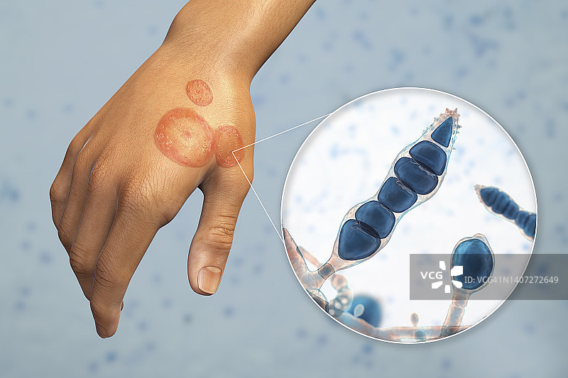 癣，图示图片素材