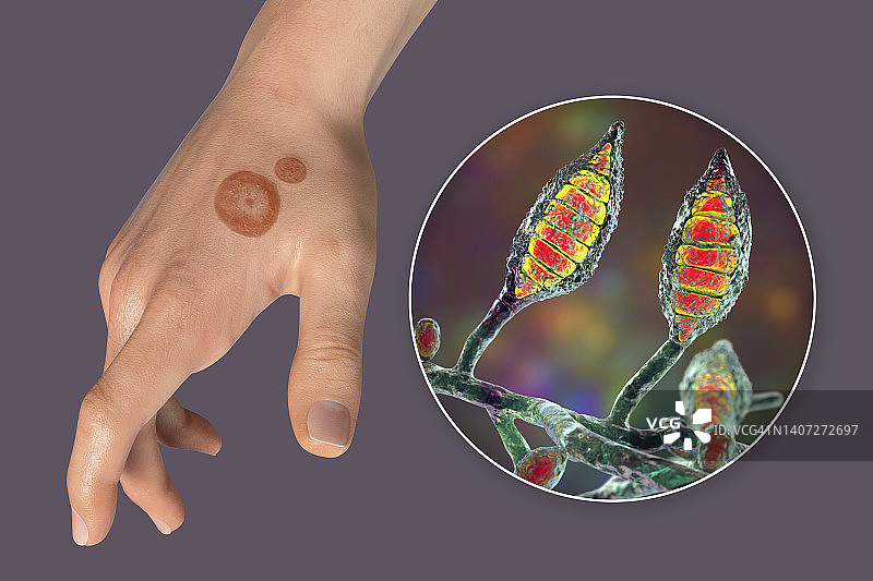 癣，图示图片素材