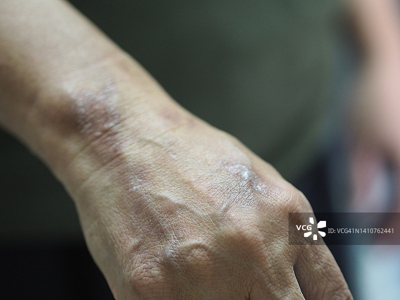 女人手背上的水泡图片素材