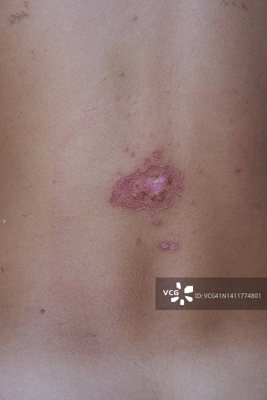 脓疱病感染伤口图片素材