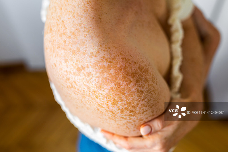 肩部的雀斑图片素材