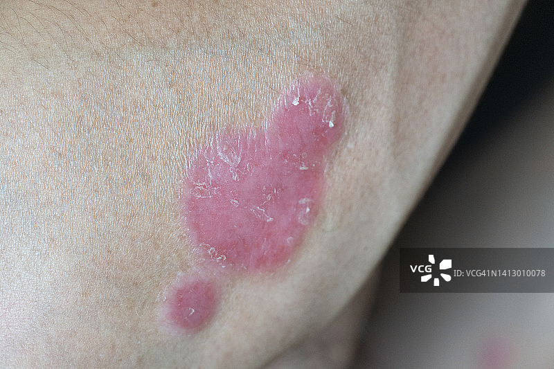 手臂上发炎的牛皮癣斑块图片素材