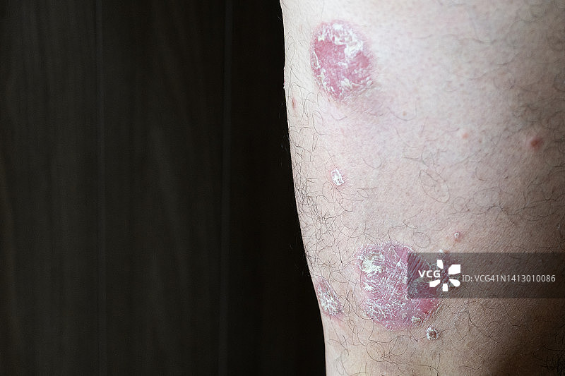 大腿上发炎的牛皮癣图片素材