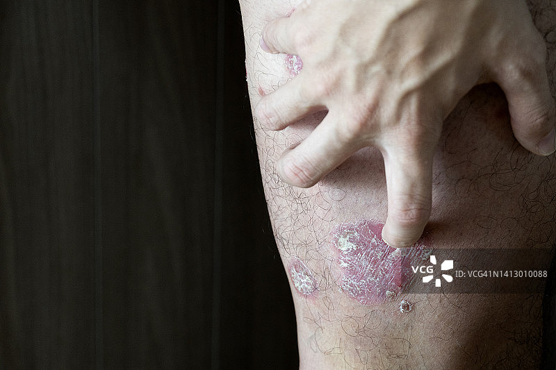 大腿上银屑病的抓痕图片素材