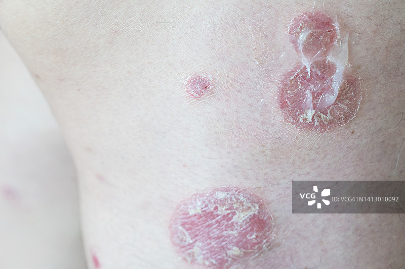 涂抹润肤霜的腿部银屑病斑块图片素材