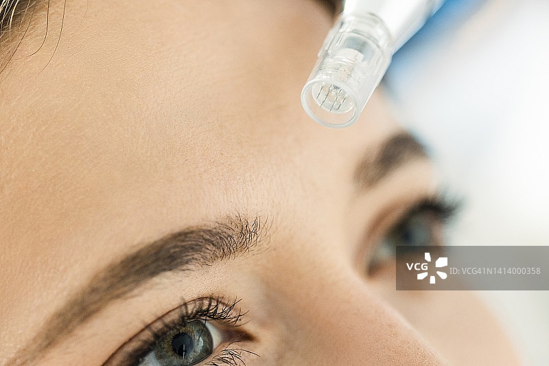 额头特写：患者皮肤上的皮肤针刺美容治疗图片素材