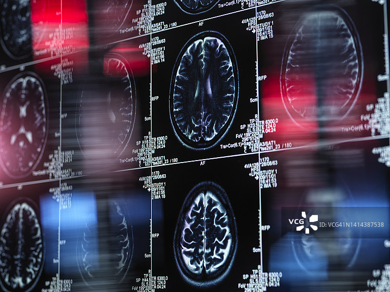 阿尔茨海默病与痴呆症研究概念图图片素材