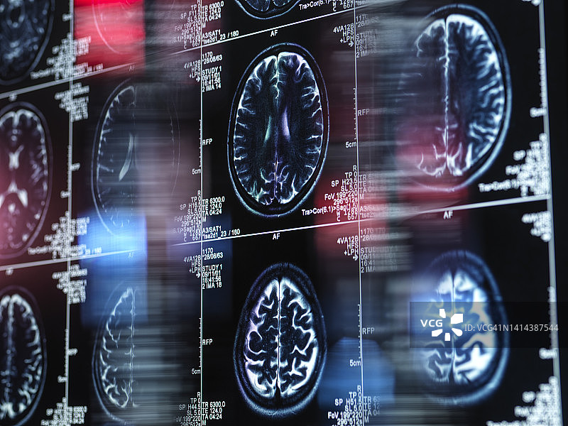 阿尔茨海默病与痴呆症研究概念图图片素材