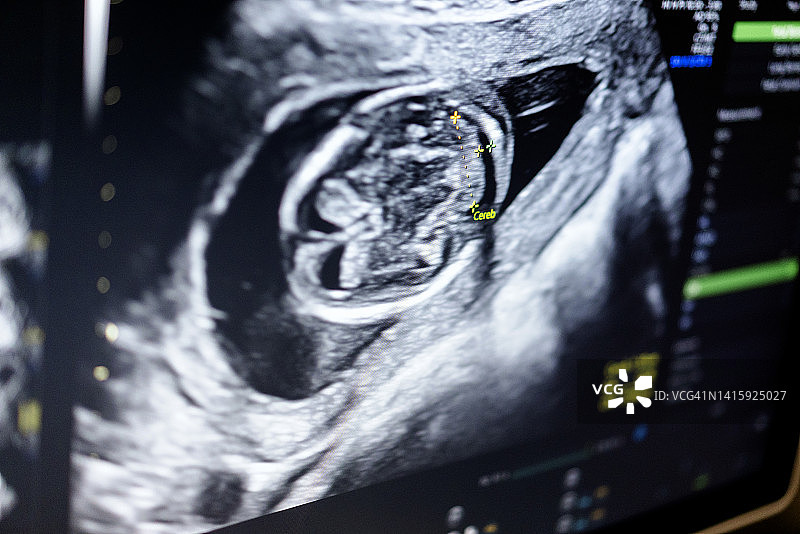 医生使用超声波扫描仪监测12周胎龄的怀孕患者图片素材