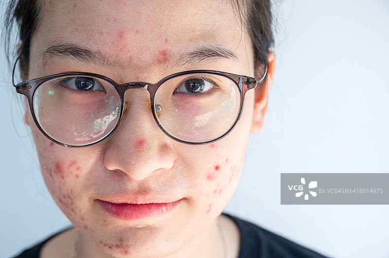 长有痤疮的年轻亚洲女性头像，未化妆的自然肌肤图片素材