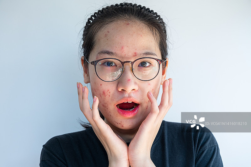 面部痤疮发炎的亚洲女性 портрет图片素材