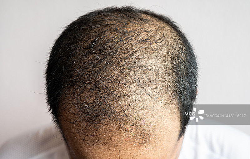 男性脱发头部俯视图图片素材