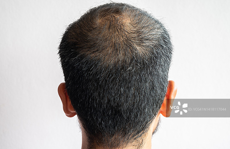 男性头顶脱发概念图图片素材