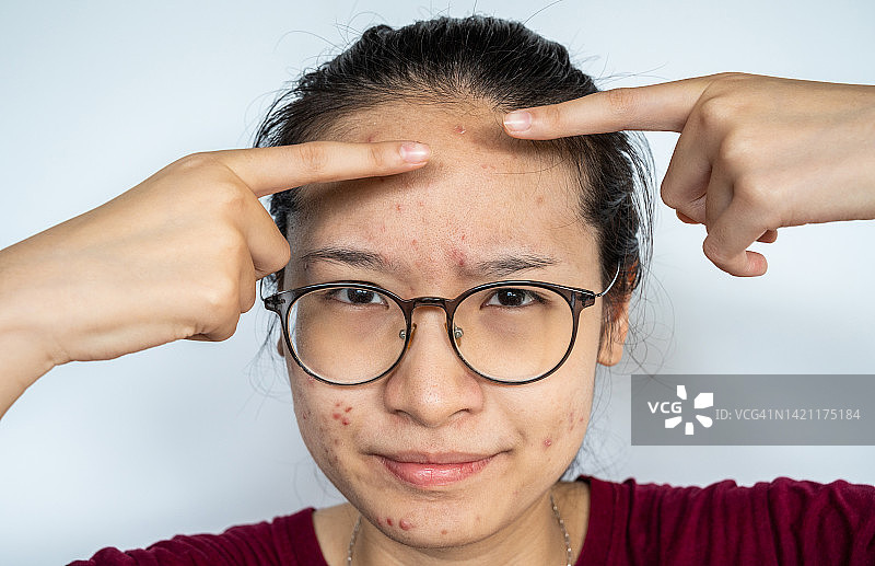指着额头粉刺的年轻亚裔女性头像图片素材