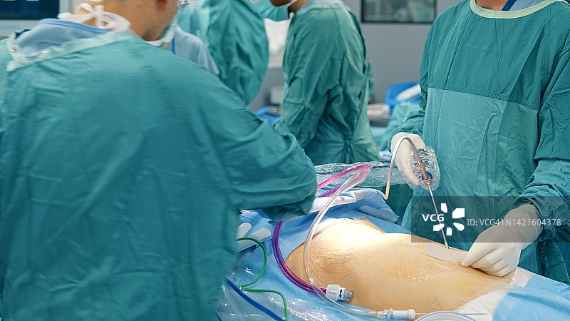 外科医生和护士在医院进行腹腔镜手术图片素材